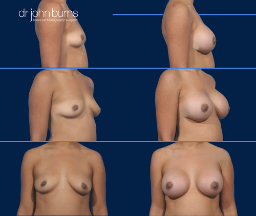 Before & After Dallas Breast Augmentation- Top Plastic Surgeon- Dr. John Burns
