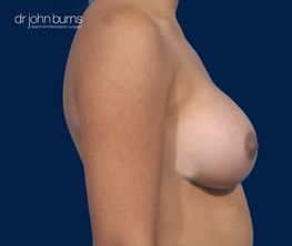 Profile View- After Dallas Breast Augmentation- Top Plastic Surgeon- Dr. John Burns
