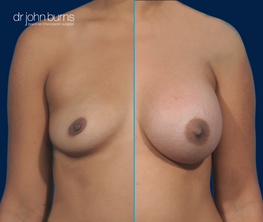 Split screen- Before & After Dallas Breast Augmentation- Top Plastic Surgeon- Dr. John Burns