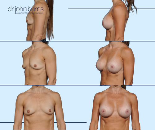 Before & After- Athletic Breast Augmentation- Dallas Breast Implants- Dr. John Burns