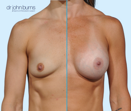 Before & After- Split Screen- Athletic Breast Augmentation- Dallas Breast Implants- Dr. John Burns