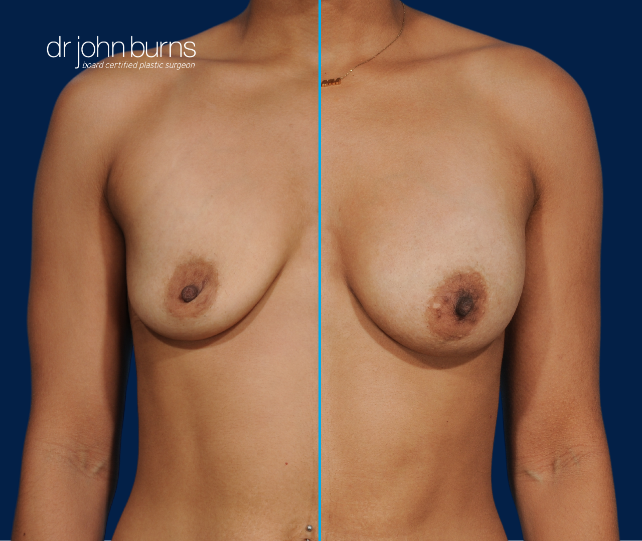 case 9- split screen before & after fat transfer to breast by top plastic surgeon, Dr. John Burns