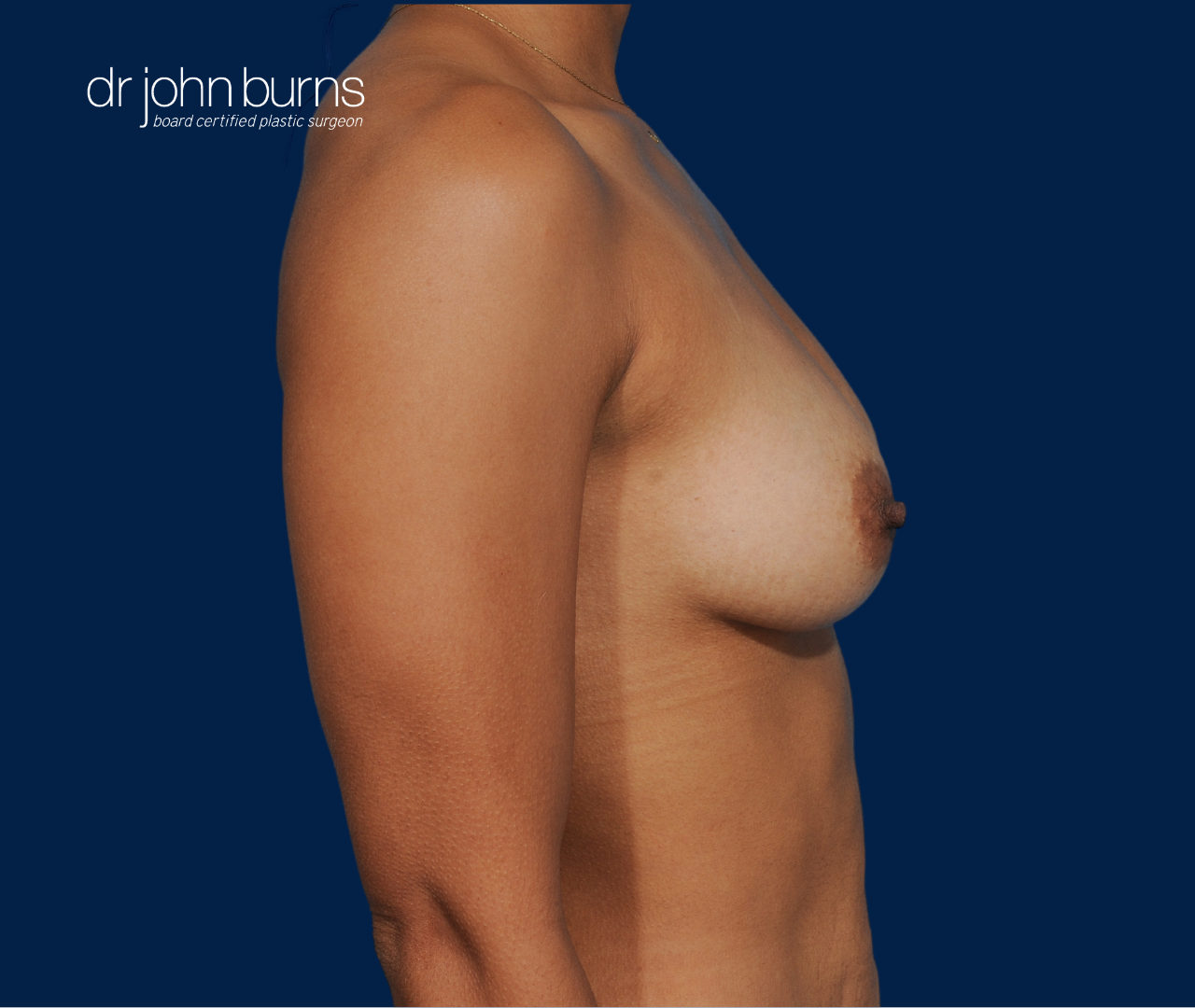 case 9- profile view | after fat transfer to breast by top plastic surgeon, Dr. John Burns