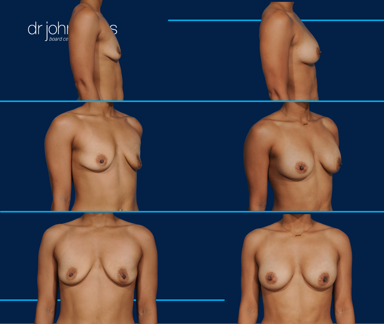 case 9- before and after breast augmentation fat transfer by top plastic surgeon, Dr. John Burns