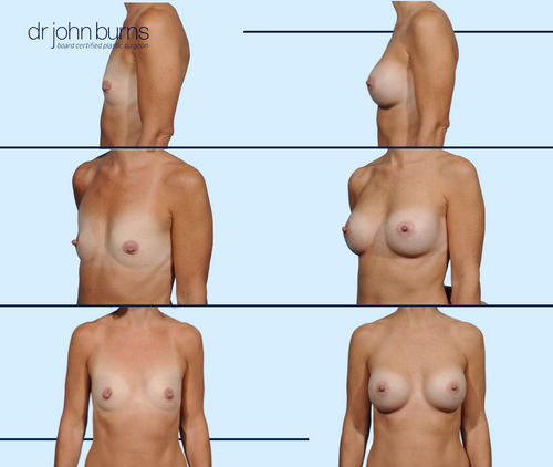 After Athletic Breast Augmentation- Dallas Breast Implants Results- Dr. John Burns