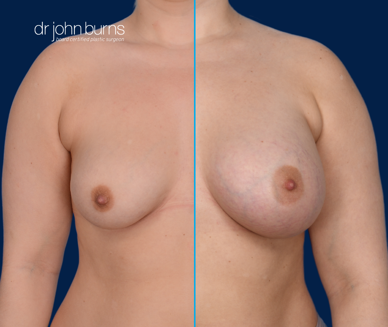 before and after breast implants- Dallas, Texas- Dr. John Burns
