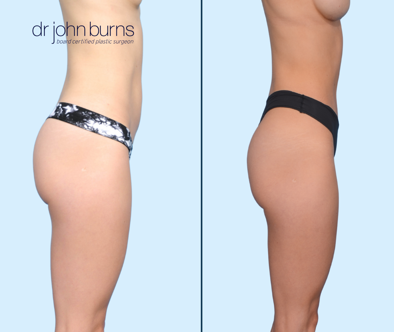 Case 12- Profile View- Before & After Tiny Tummy Tuck with Lipo 360 by Dr. John Burns