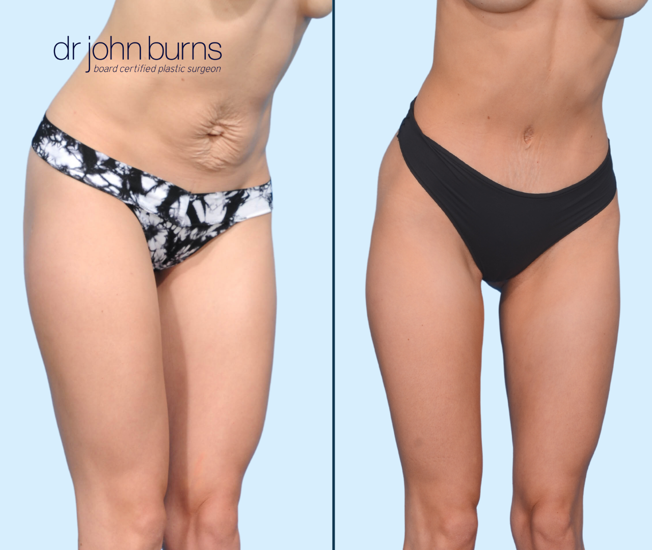 Case 12- 45 Degree View- Before & After Tiny Tummy Tuck with Lipo 360 by Dr. John Burns