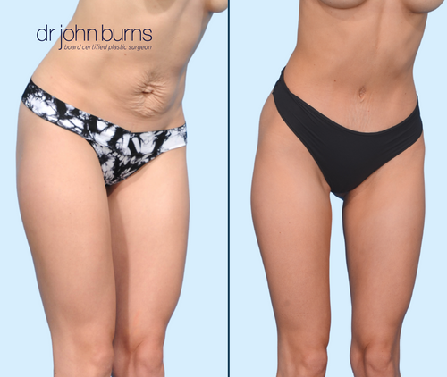 5 Secrets For Nearly Invisible Tummy Tuck Scars- Dr. John Burns