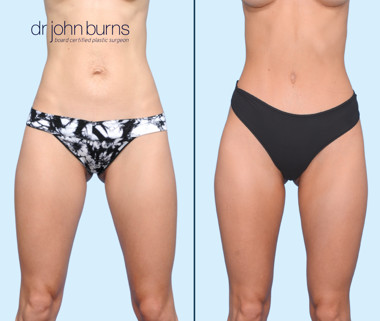 Case 12- Front View- Before & After Tiny Tummy Tuck with Lipo 360 by Dr. John Burns