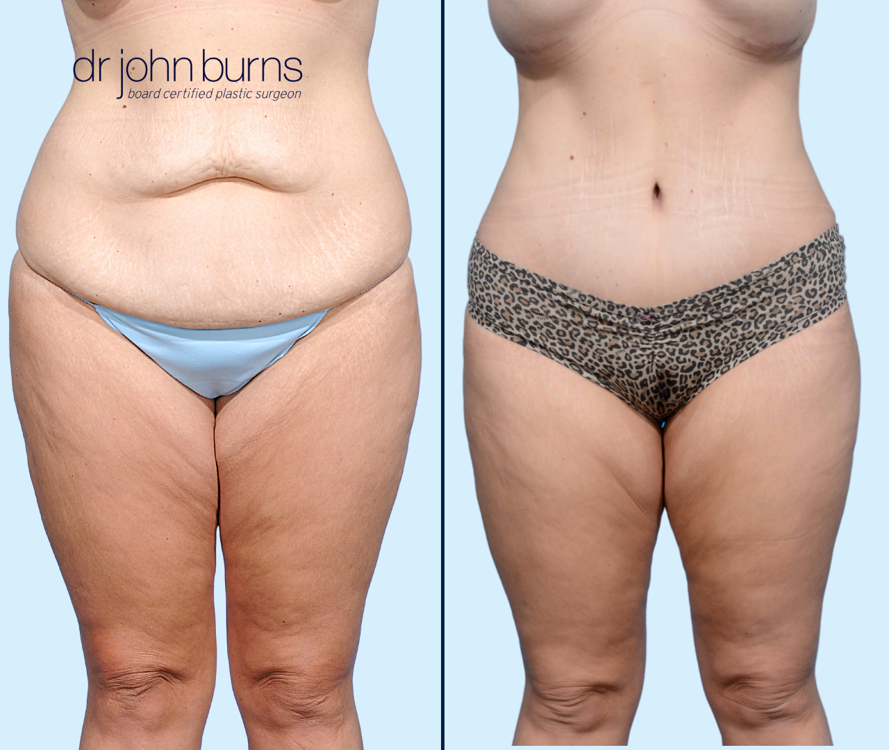 Case 13- Front View- Before & After Extended Tummy Tuck with Liposuction by Dr. John Burns