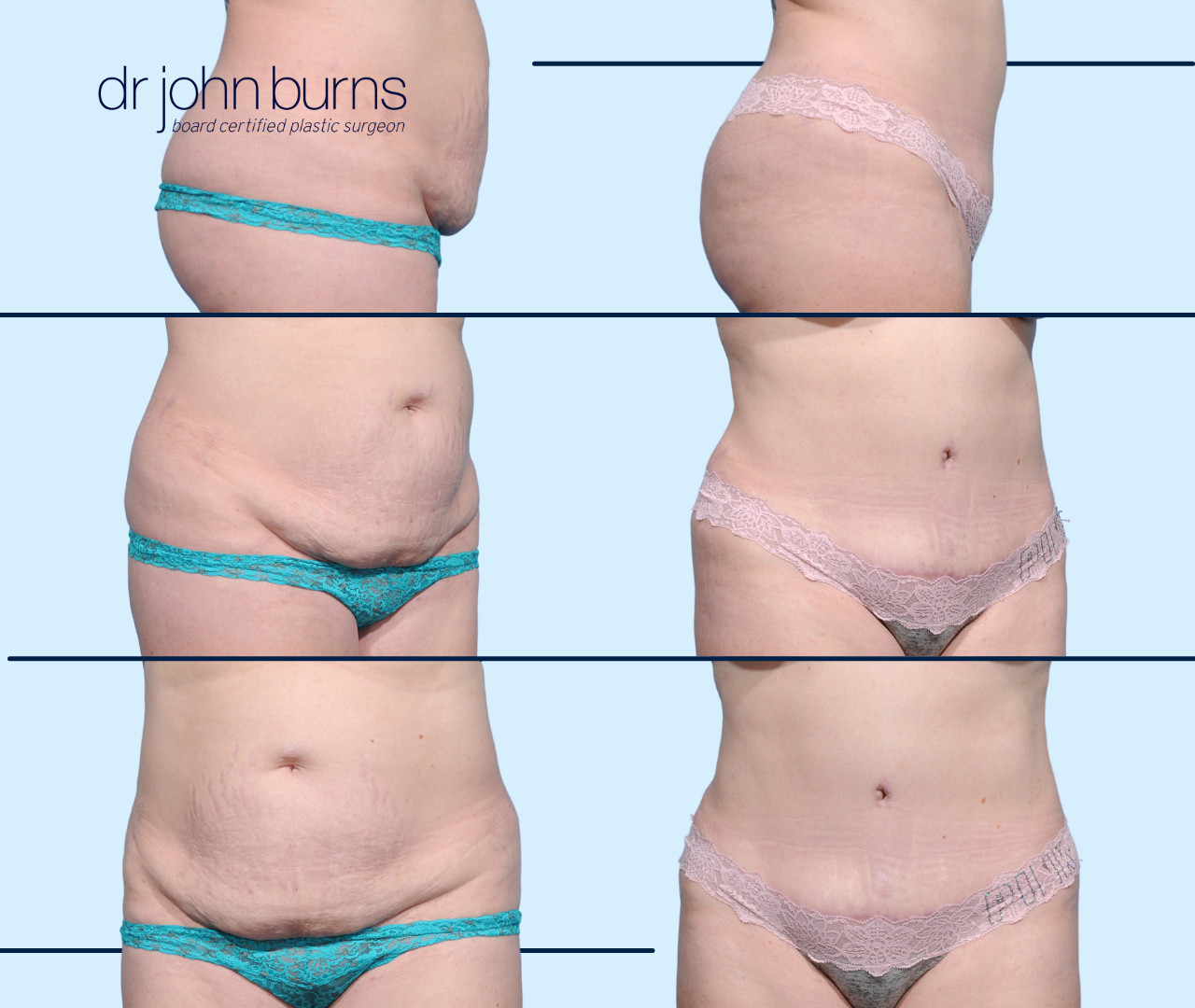 Case 15- Before & After Abdominoplasty with Lipo 360 by Dr. John Burns