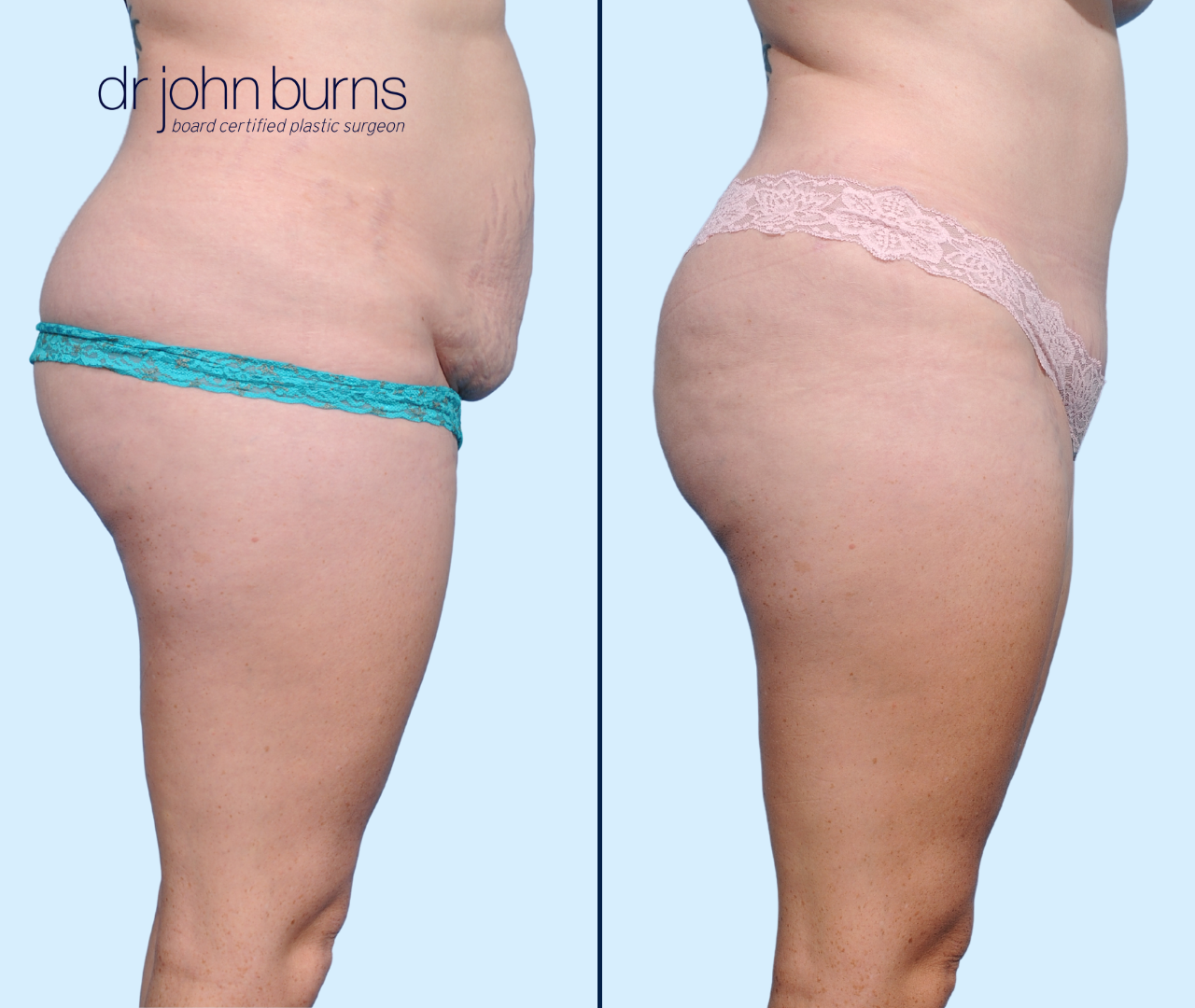 Case 15- Profile View- Before & After Abdominoplasty with Lipo 360 by Dr. John Burns
