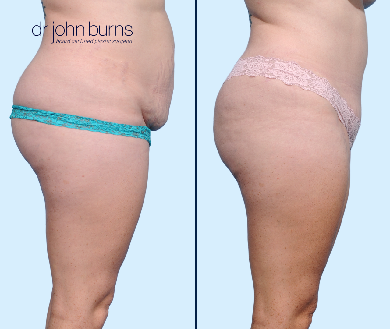 Mini Tummy Tuck- Lipo 360 by Dallas Plastic Surgeon Dr. John Burns