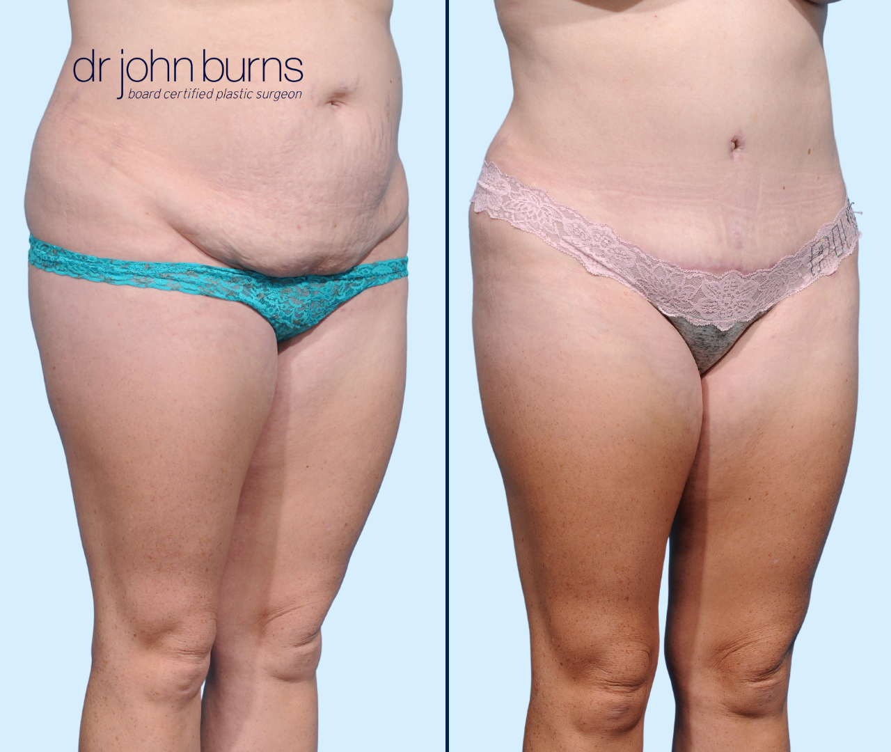 Case 15- 45 Degree View- Before & After Abdominoplasty with Lipo 360 by Dr. John Burns