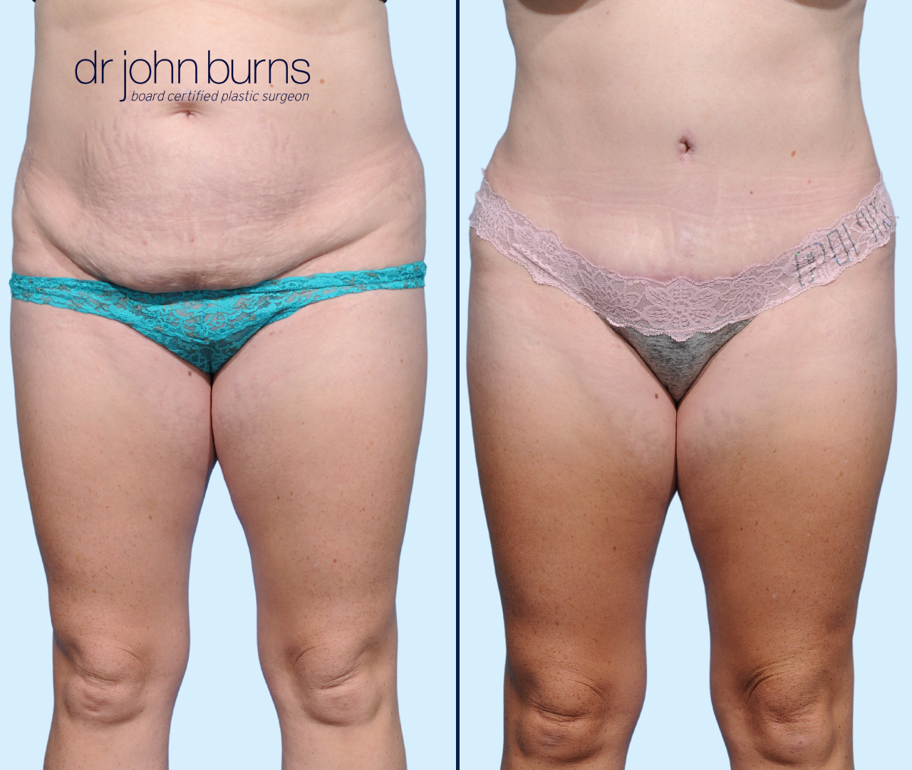 Case 15- Front View-Before & After Abdominoplasty with Lipo 360 by Dr. John Burns