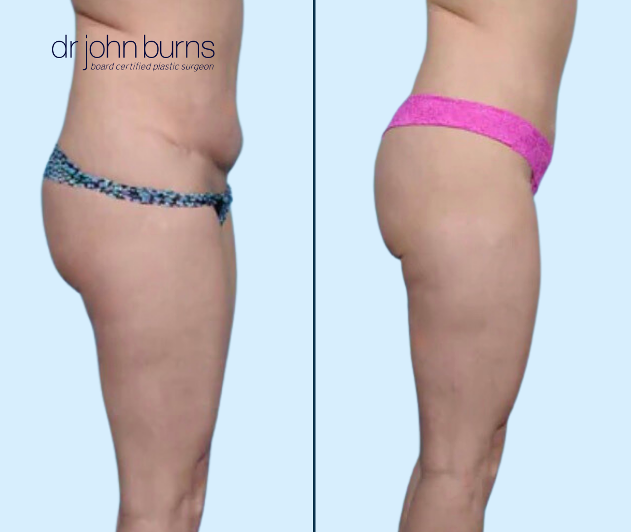 Case 1- Profile View- Tummy Tuck Revision with Lipo 360- Dallas, Tx- Dr. John Burns