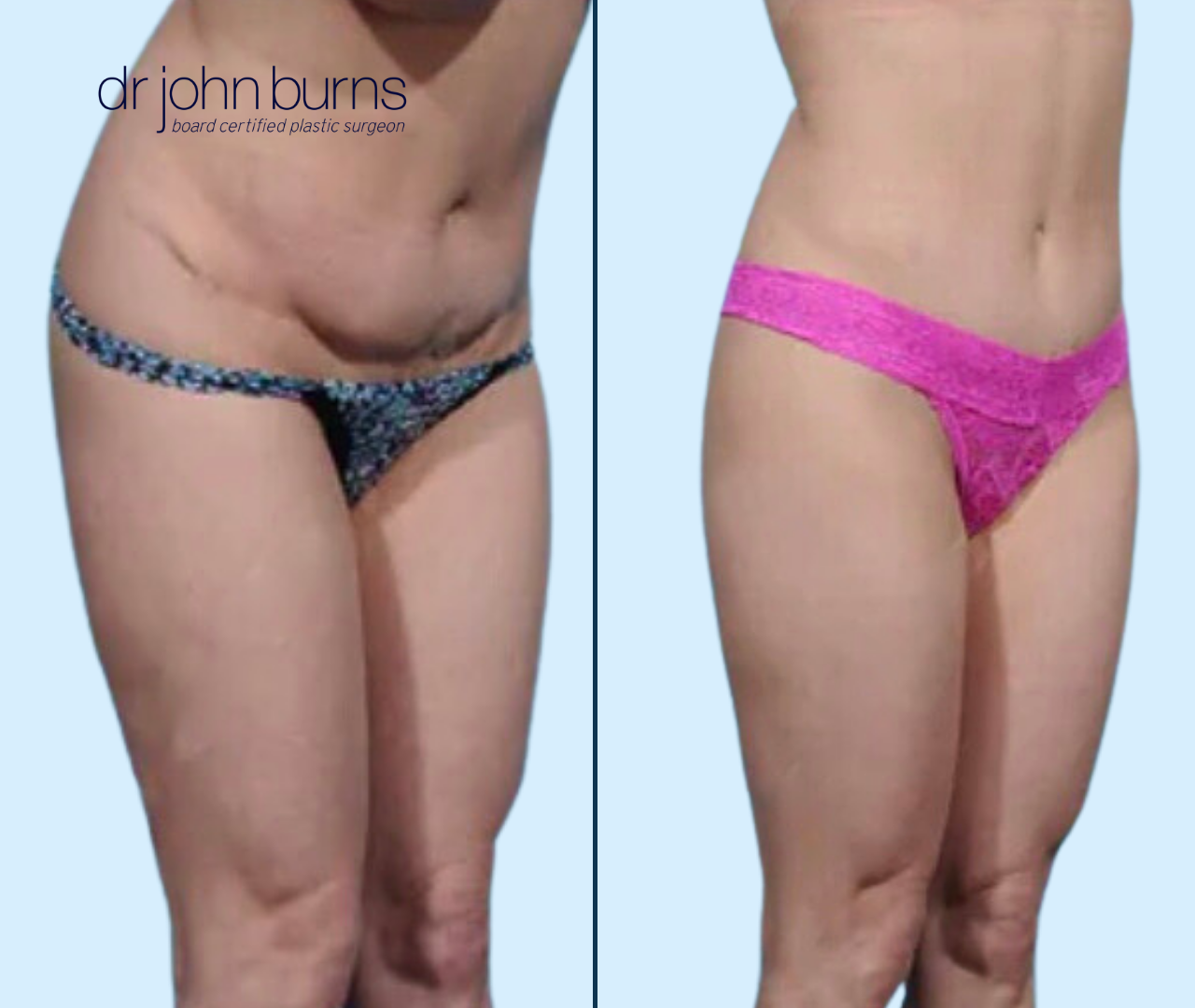 Case 1- 45 Degree View- Tummy Tuck Revision with Lipo 360- Dallas, Tx- Dr. John Burns