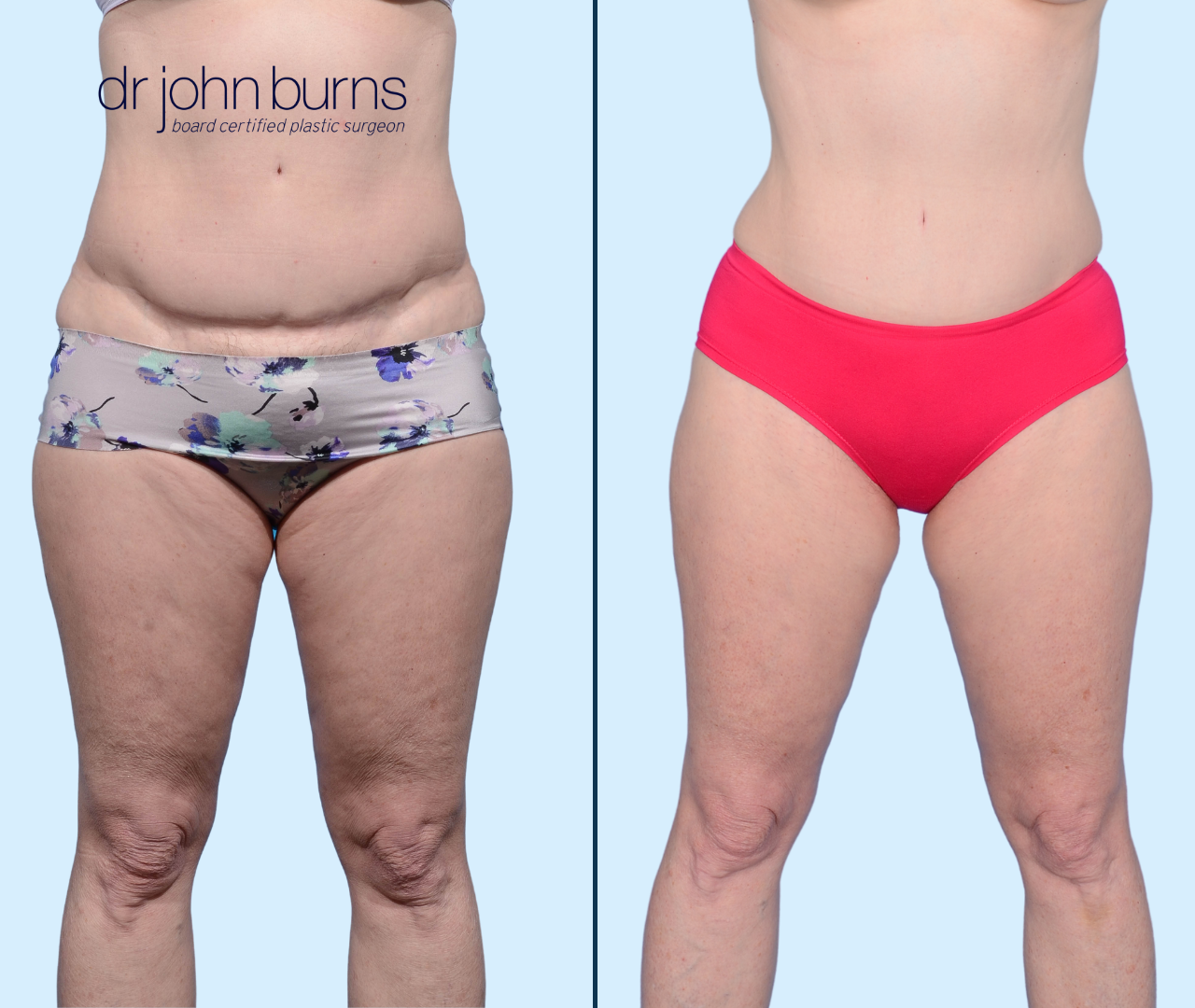 Case 2-Front View- Tummy Tuck Revision with Liposuction by Dr. John Burns