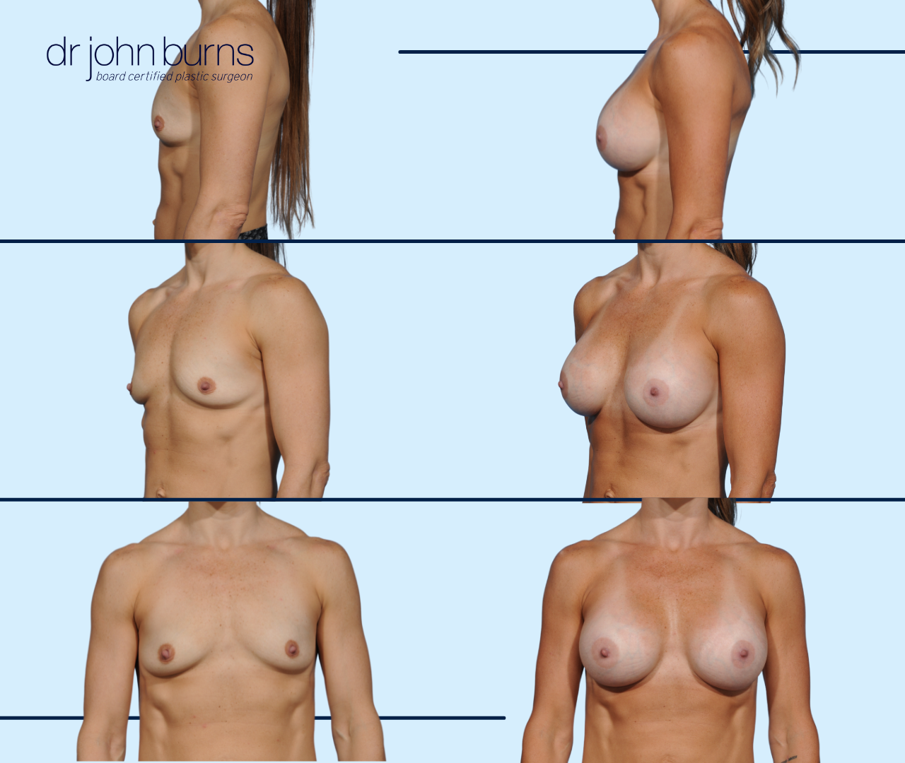 Dallas Breast Implants- Before and After Breast Implants in Dallas, Texas