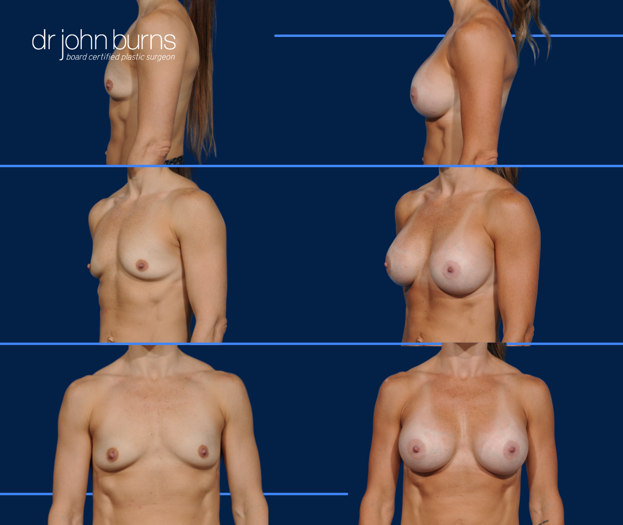 breast augmentation with silicone gel implants.png__PID:8e199a24-7155-4591-8795-f2a6de916019