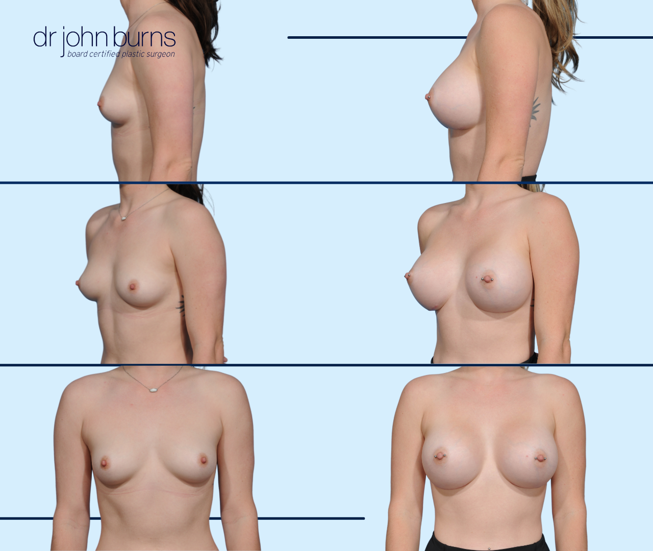 Dallas Breast Implants- Before and After Breast Implants in Dallas, Texas