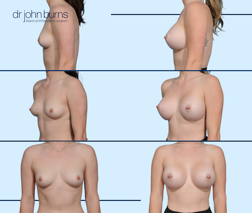 Breast Augmentation Before and After by Dr. John Burns