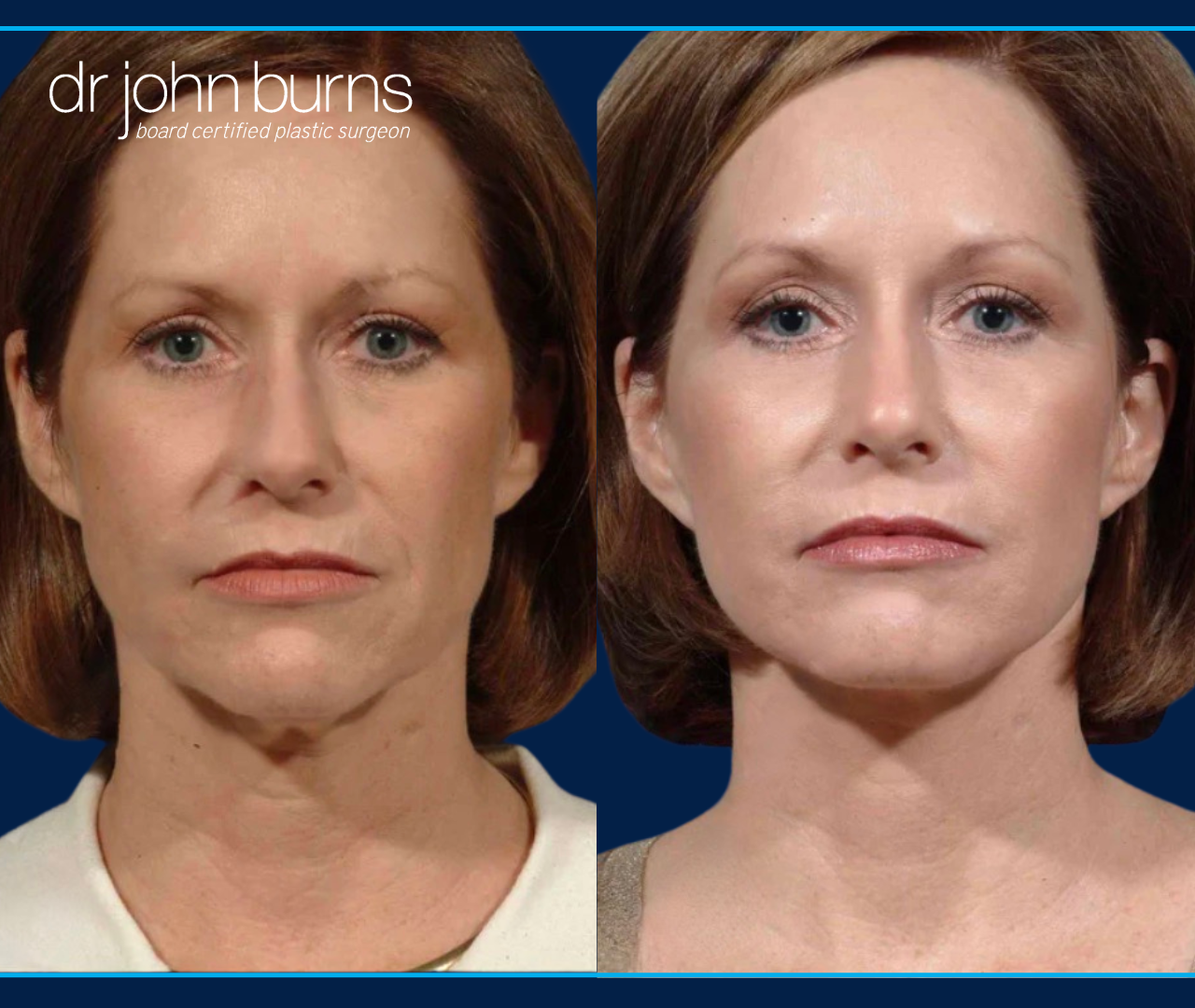Before and After Dallas Mini Facelift and Rhinoplasty by Dr. John Burns