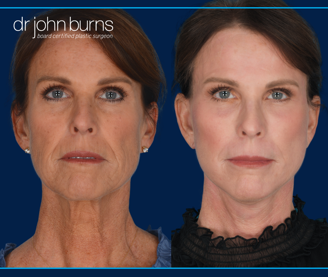 Dallas Facelift Before and After-Full Facelift Results-Dr. John