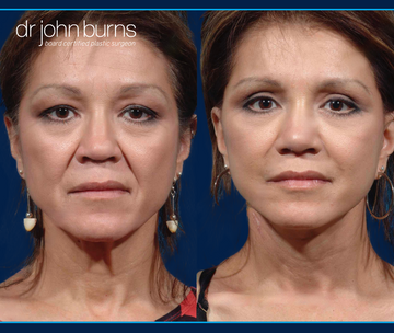 Facelift and Upper Blepharoplasty by Dallas Plastic Surgeon, Dr. John Burns