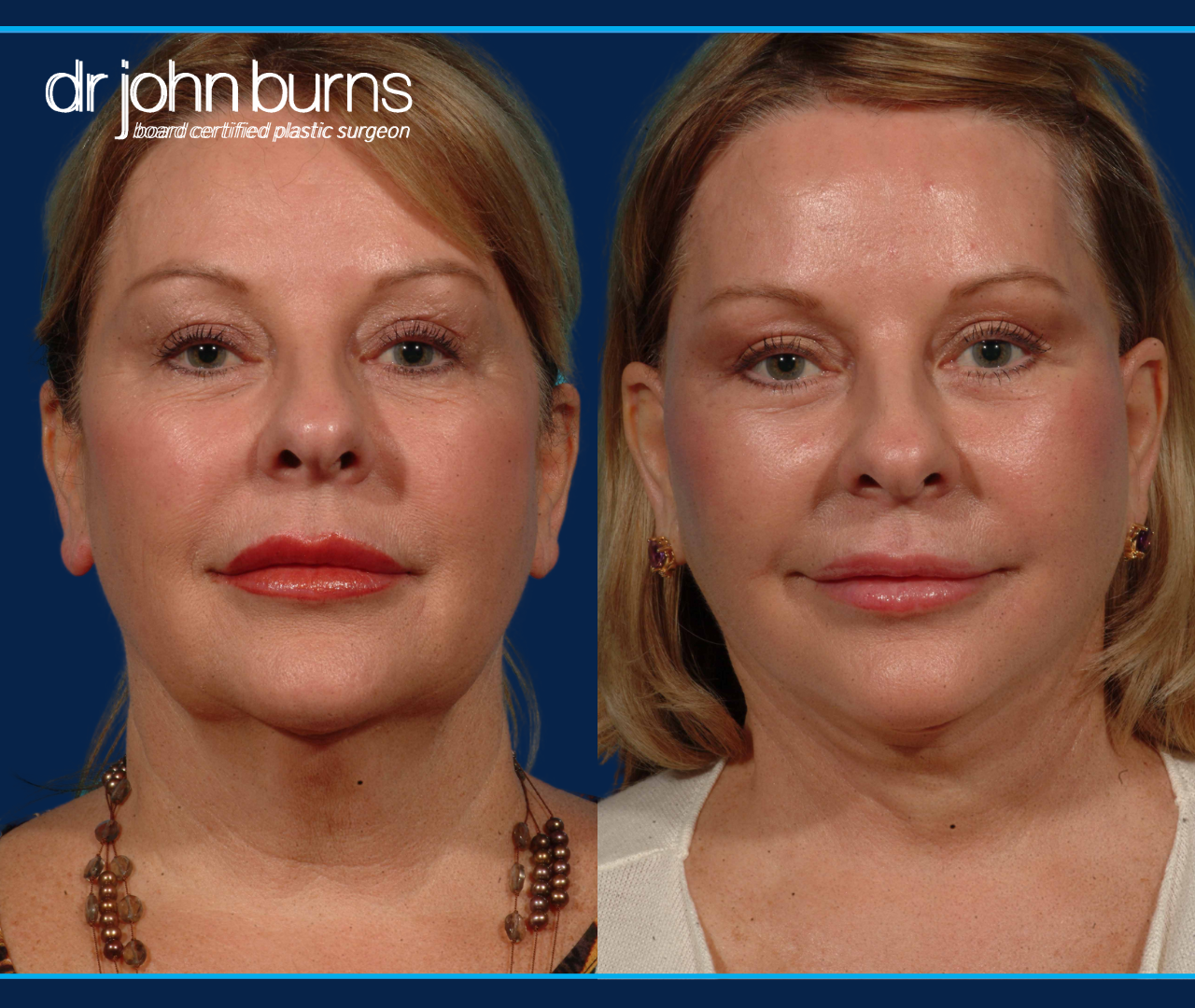 Before and after facelift by Dallas Facelift Specialist, Dr. John Burns