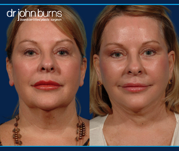 Before and After of a Caucasian Woman who had a full facelift