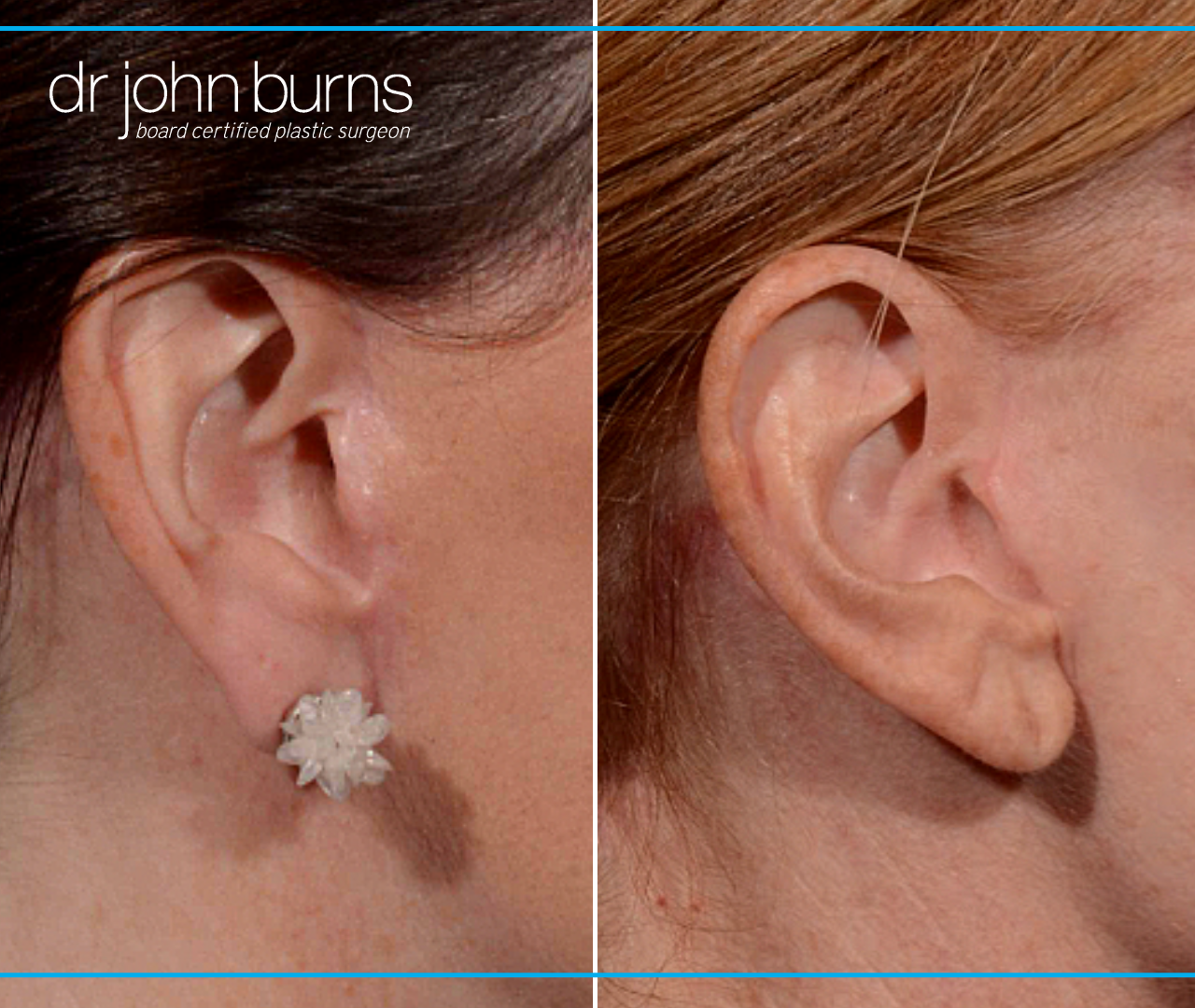 Before and After Profile View of a Mini Facelift with Rhinoplasty and Laser Resurfacing