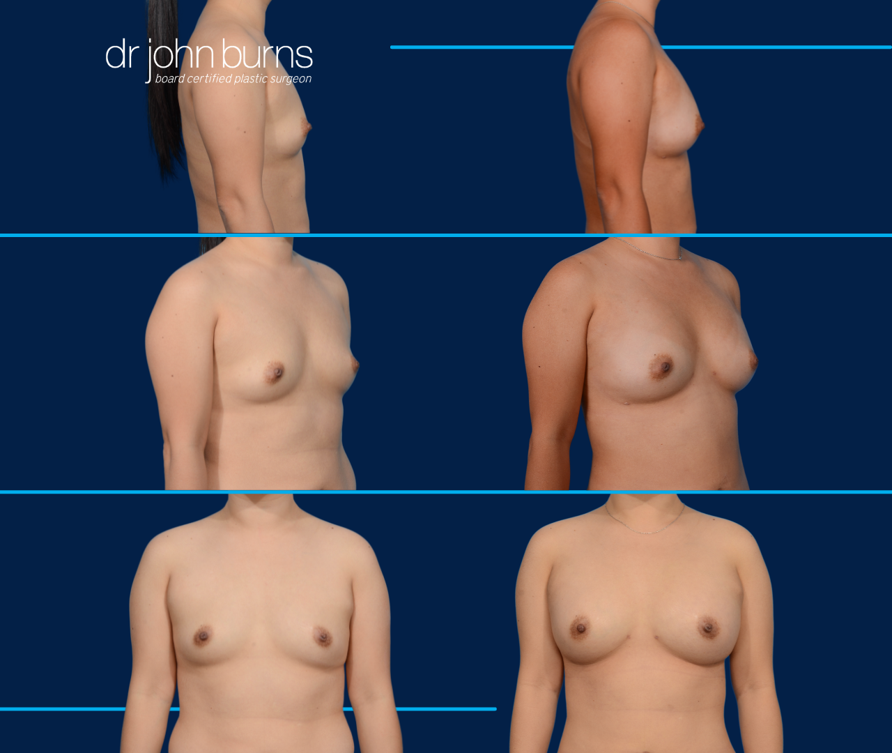 Before and After Fat grafting to breasts