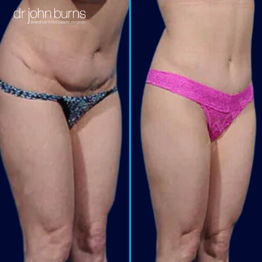 Tummy Tuck Revision Surgery Before and After