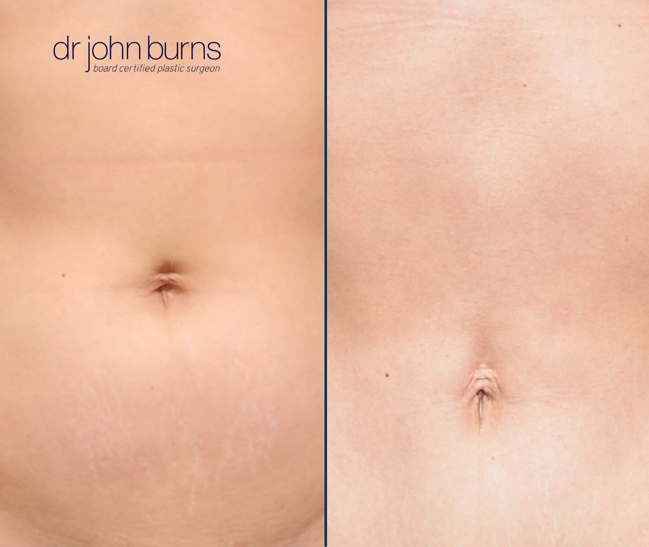 Before & After Umbilical Float with a mini tummy tuck by Dr. John Burns
