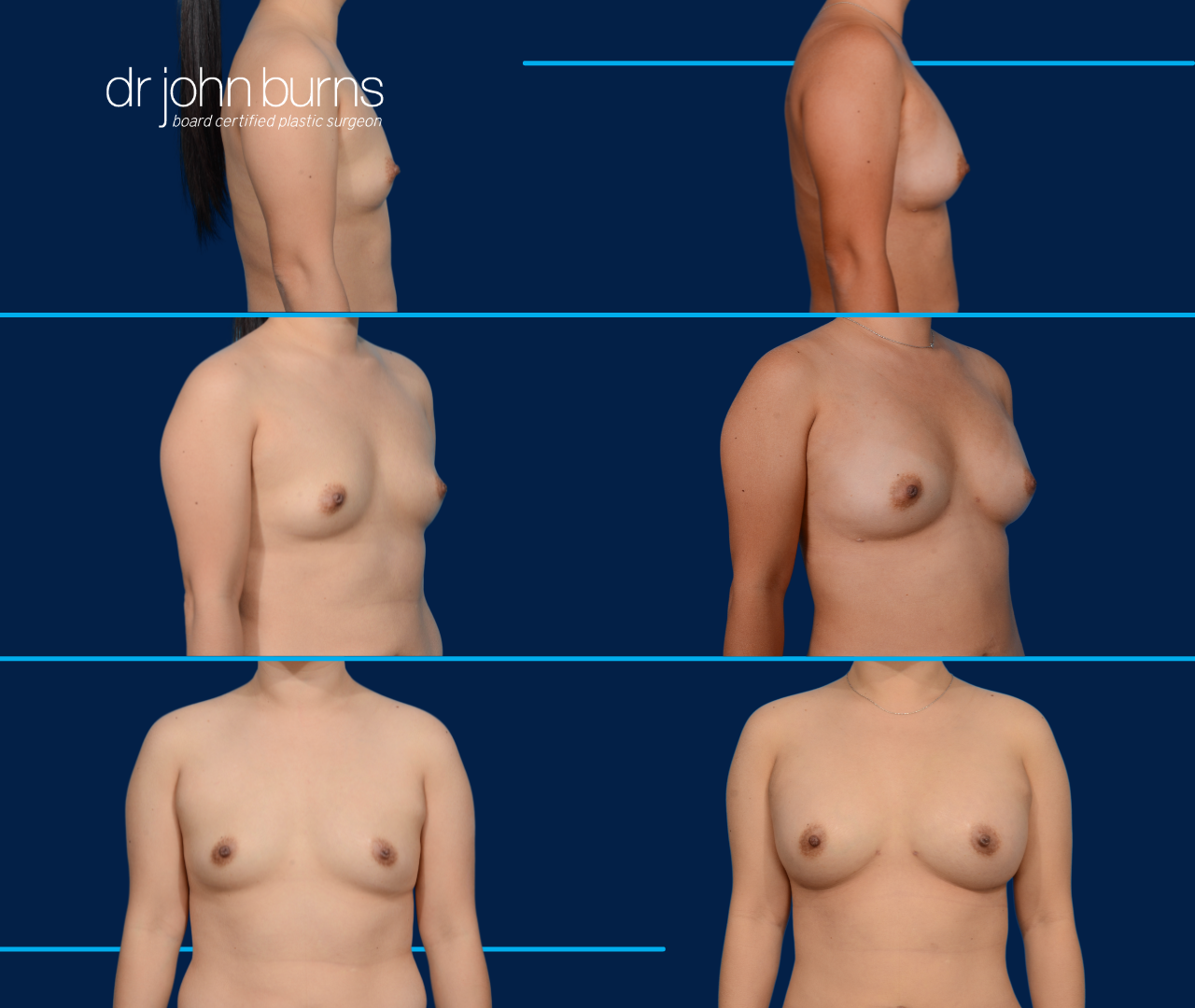 before and after breast augmentation fat transfer by top plastic surgeon, Dr. John Burns