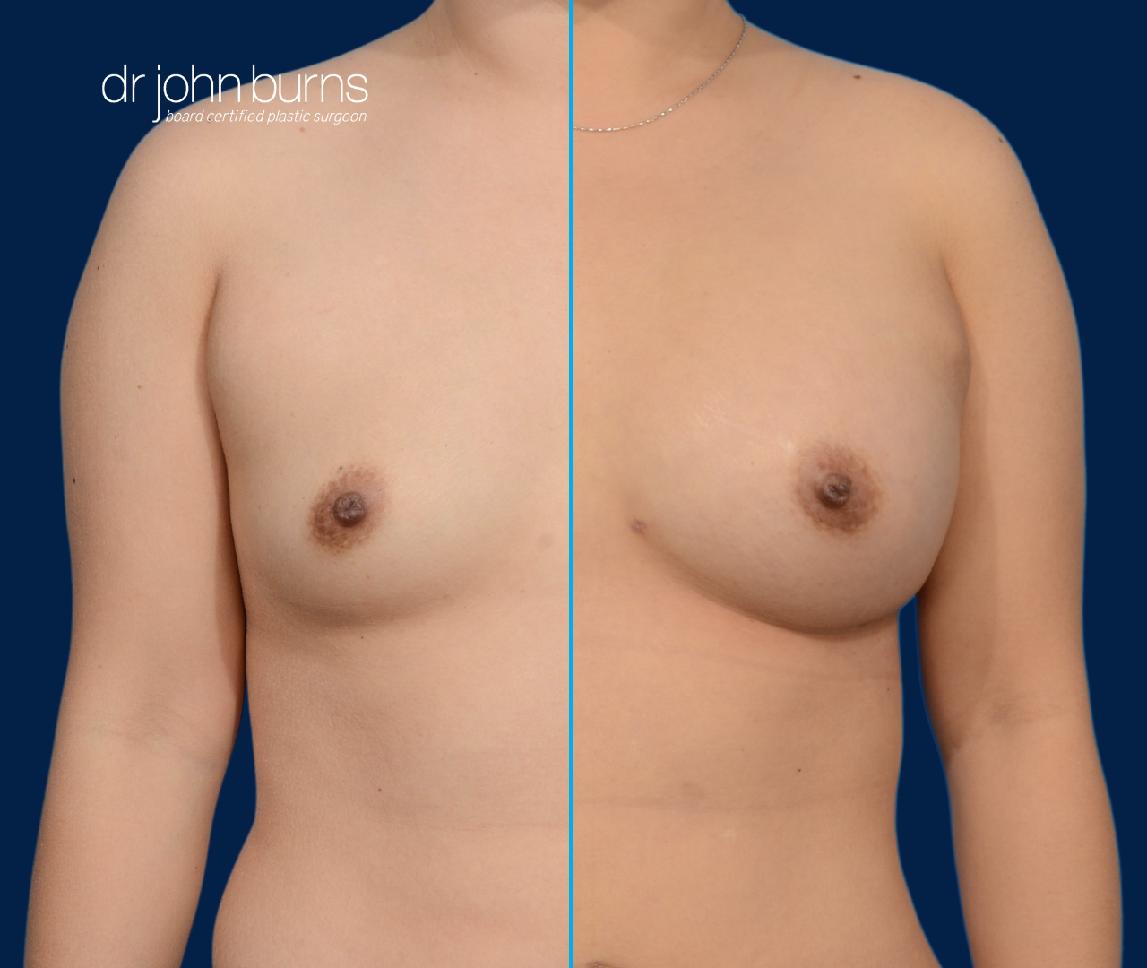case 1- split screen before & after fat transfer to breast by top plastic surgeon, Dr. John Burns