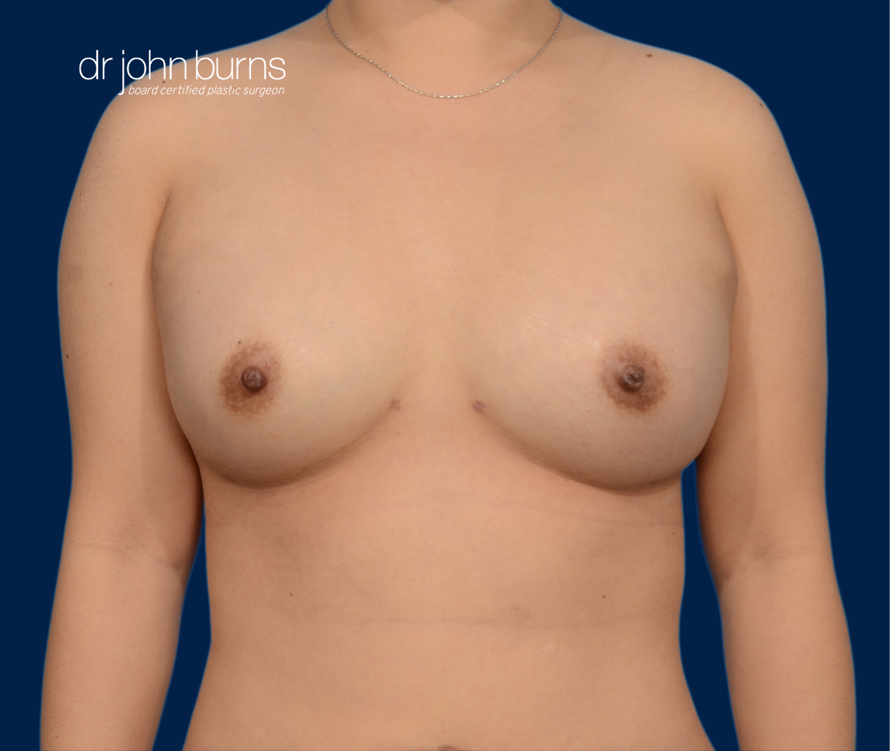 case 1- after fat transfer to breast by top plastic surgeon, Dr. John Burns