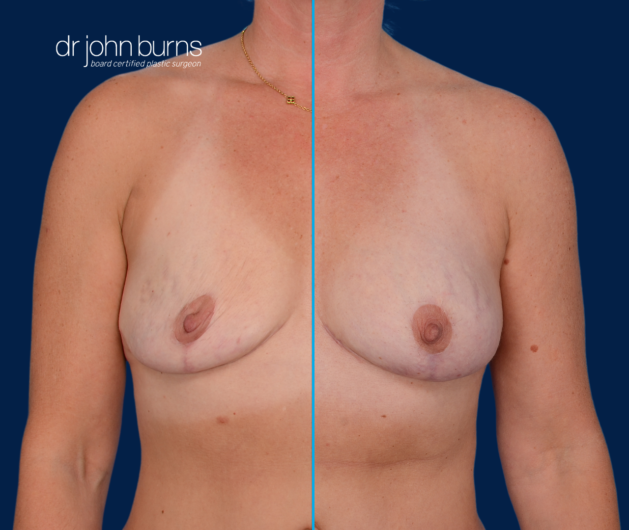 case 2- split screen before & after fat transfer to breast by top plastic surgeon, Dr. John Burns