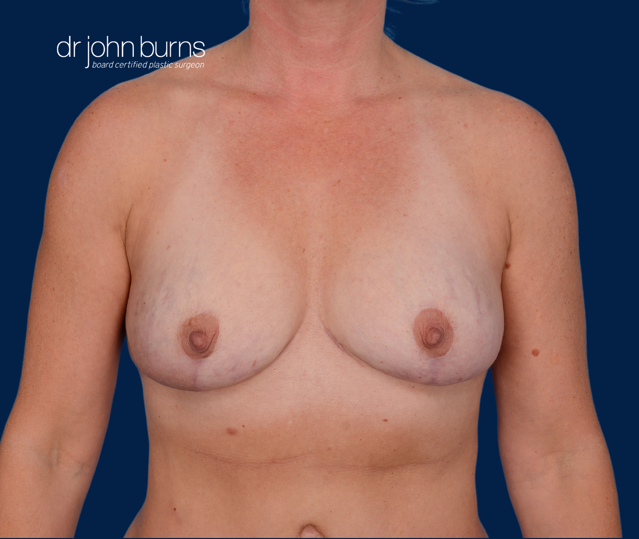 case 2- after fat transfer to breast by top plastic surgeon, Dr. John Burns
