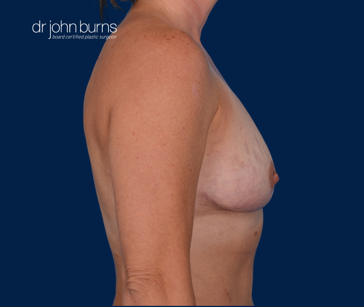 case 1- profile view | after fat transfer to breast with breast life by top plastic surgeon, Dr. John Burns
