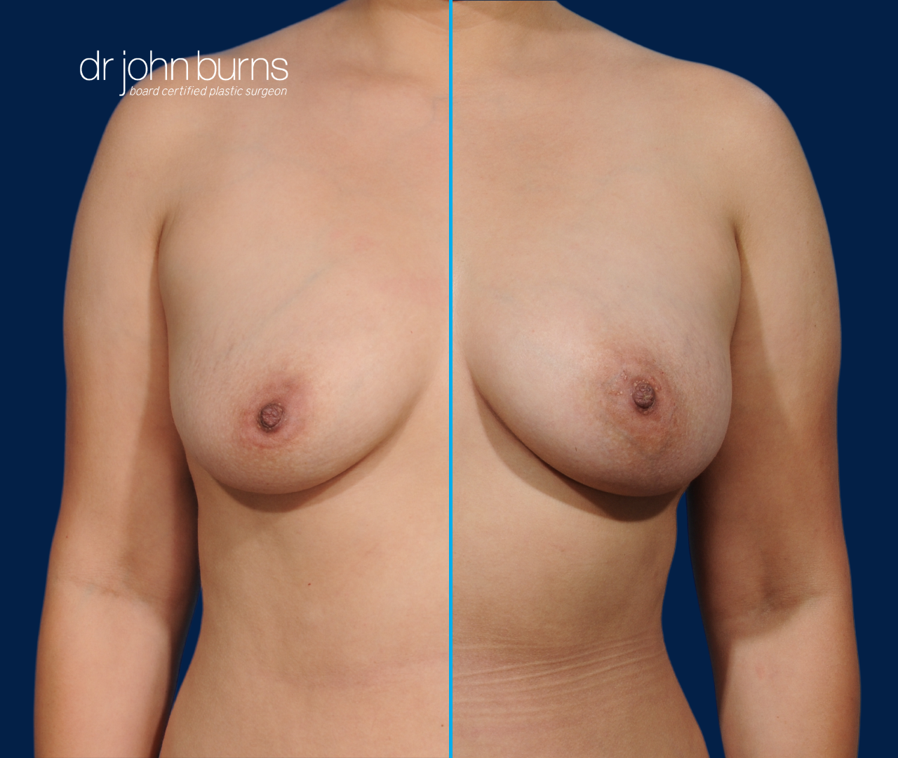 case 3- split screen before & after fat transfer to breast by top plastic surgeon, Dr. John Burns