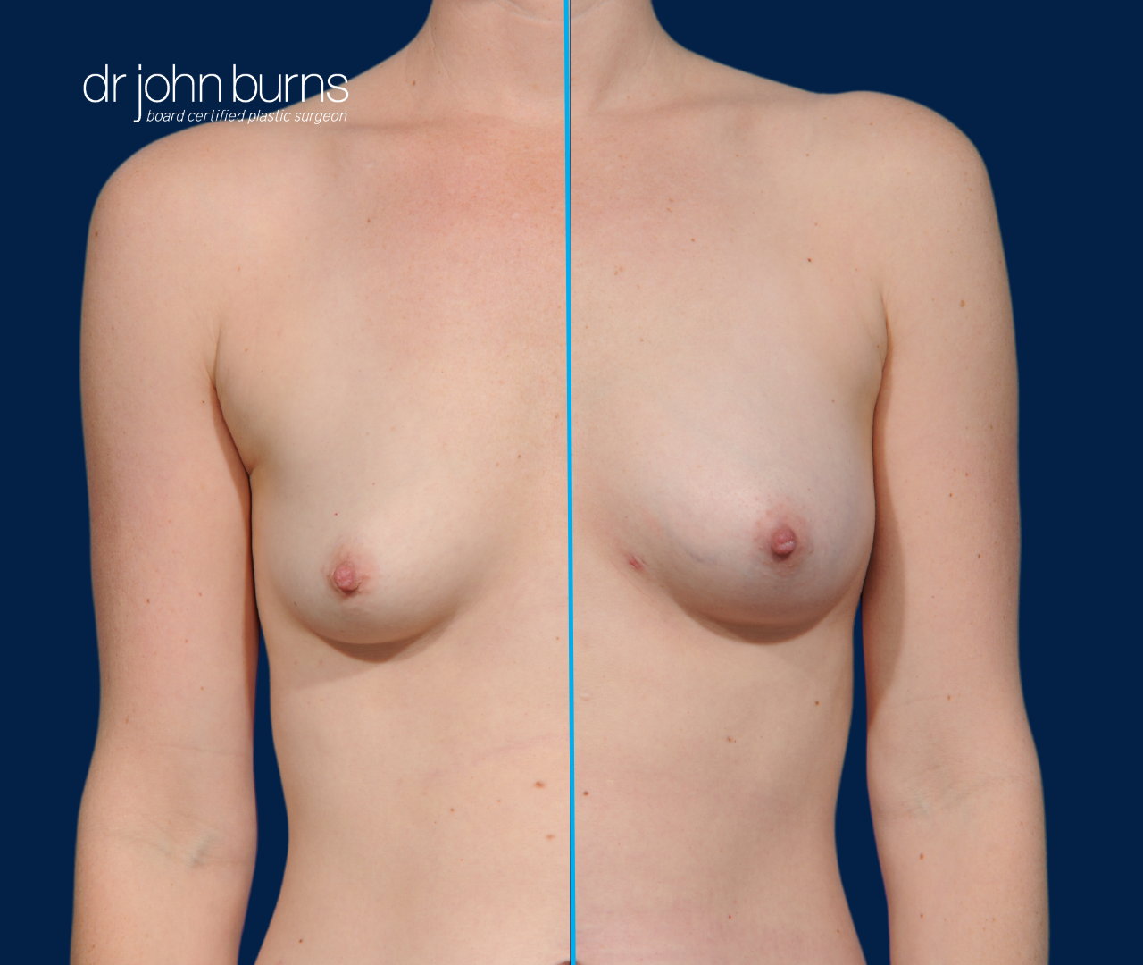 case 4- split screen before & after fat transfer to breast by top plastic surgeon, Dr. John Burns