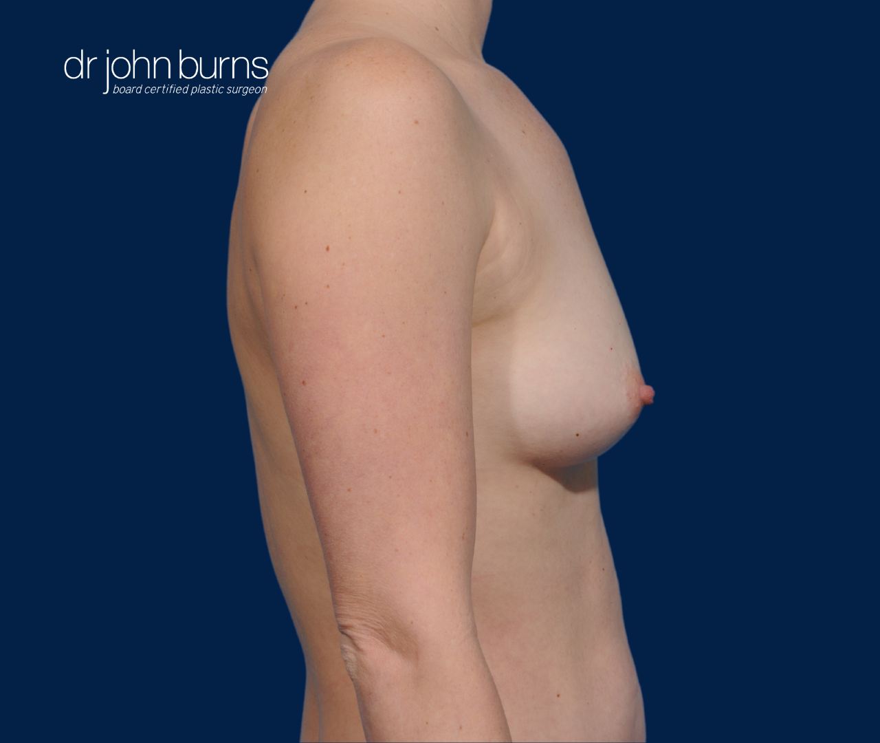 case 4- profile view | after fat transfer to breast by top plastic surgeon, Dr. John Burns