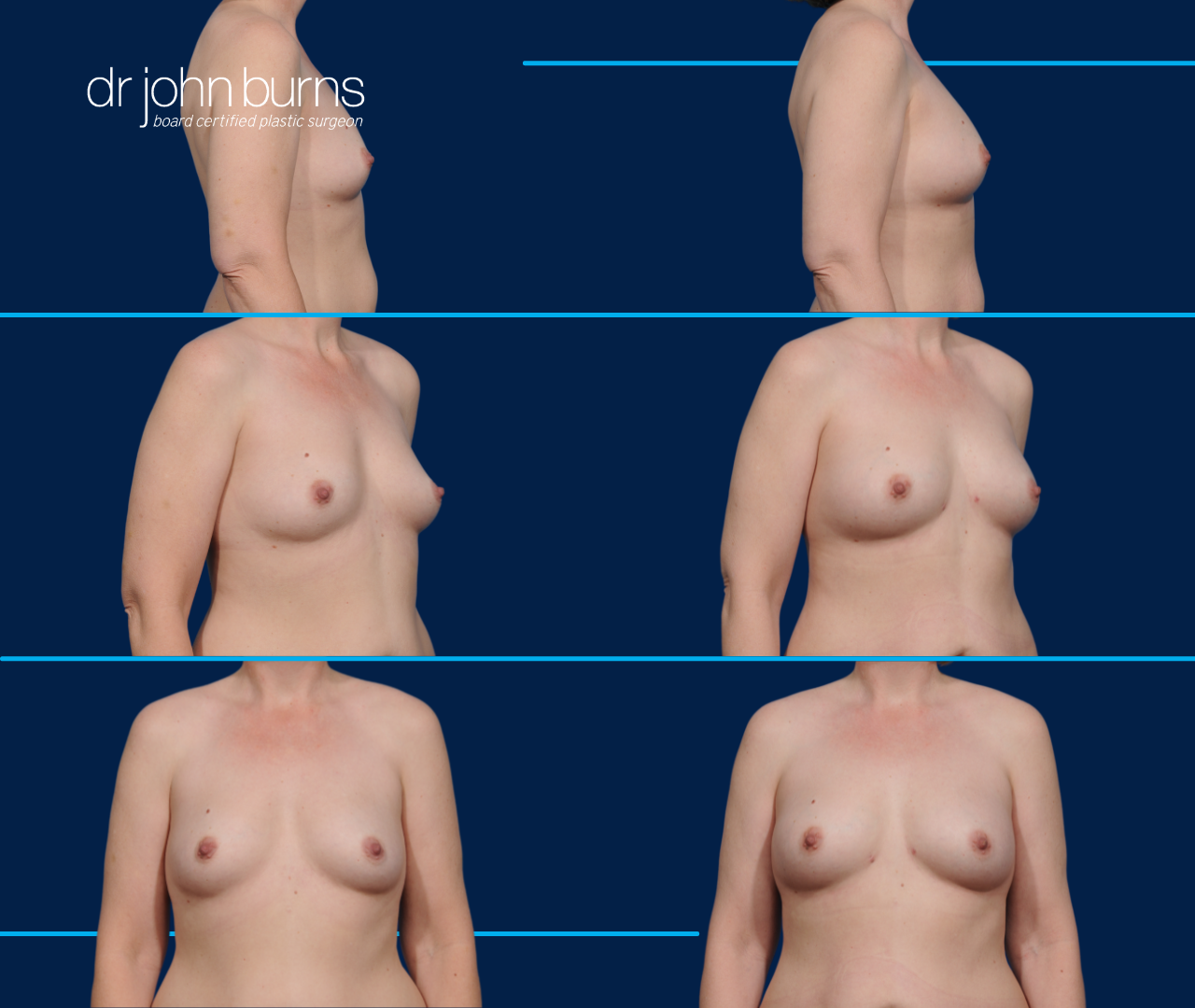 case 5- before and after breast augmentation fat transfer by top plastic surgeon, Dr. John Burns