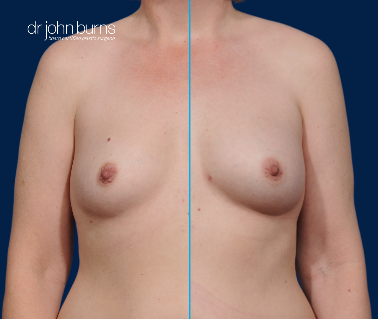 case 5- split screen before & after fat transfer to breast by top plastic surgeon, Dr. John Burns