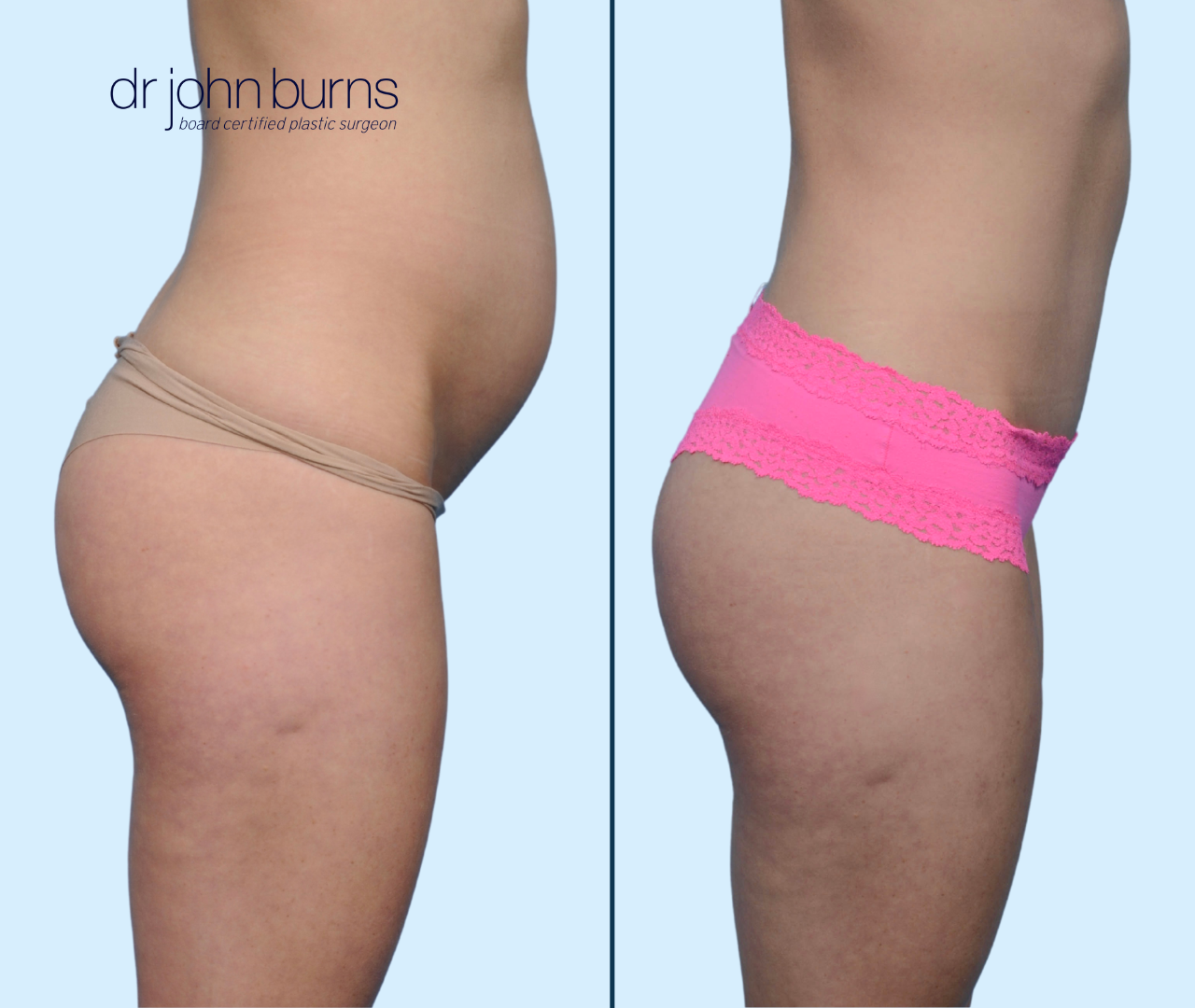 Profile View | Before & After Mini Tummy Tuck with Diastasis Recti Repair by Dr. John Burns