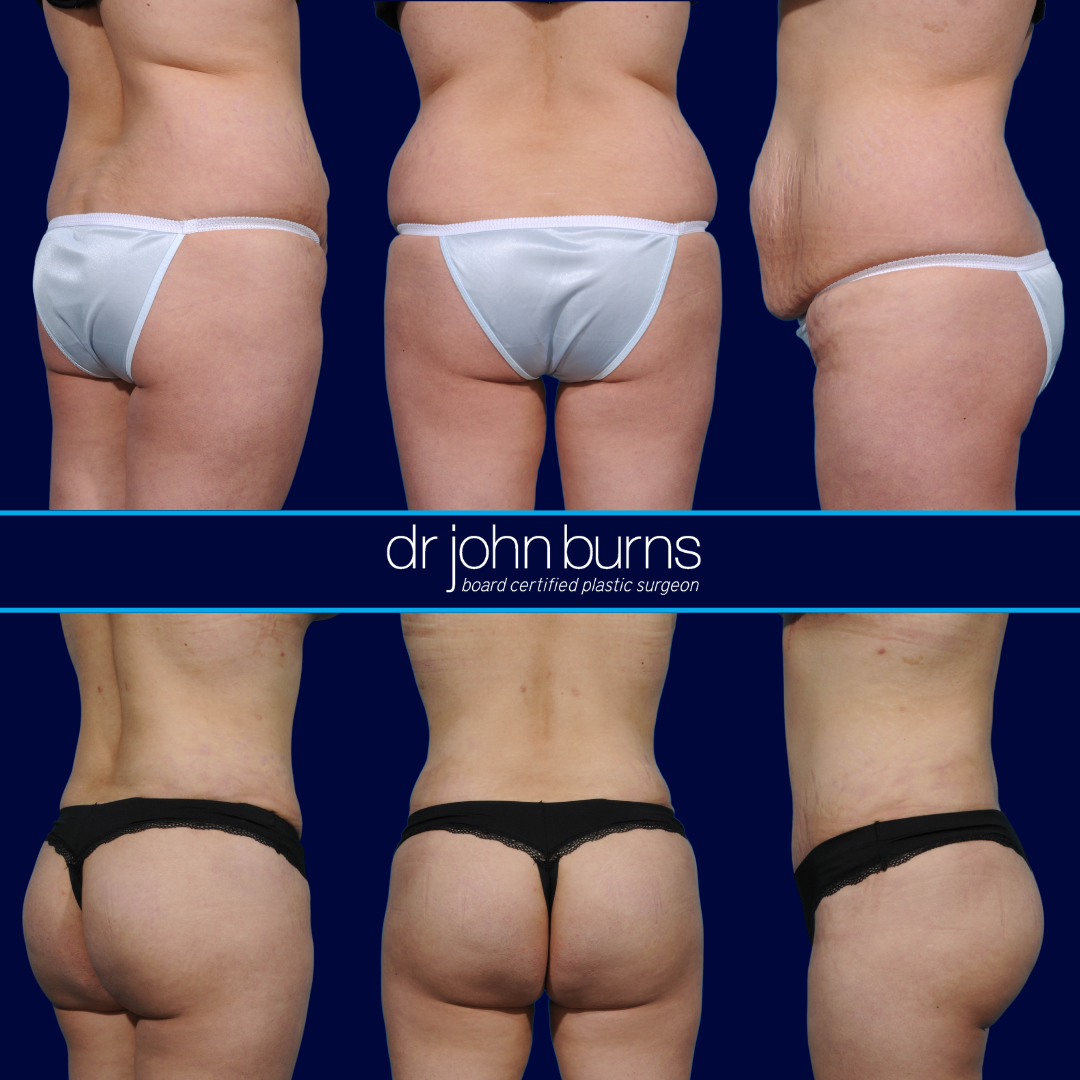 Before and After Tummy Tuck with Brazilian Butt Lift by Dr. John Burns