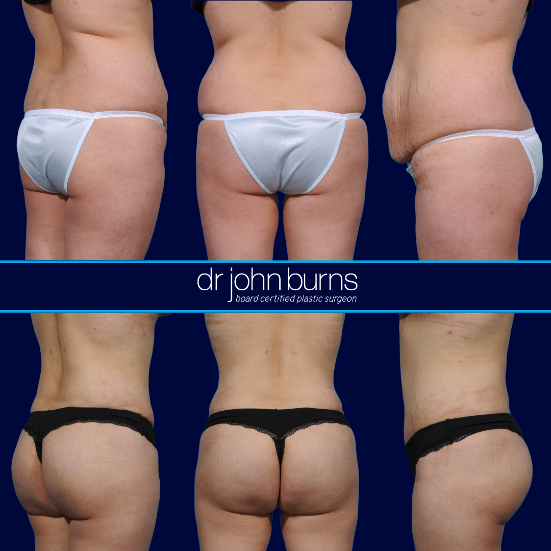 Liposuction with Buttock Augmentation Gives You an Hourglass